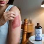 Huile de ricin et cicatrices : un remède naturel pour une peau régénérée